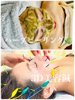 12月限定🈹🎄ごわつき、ニキビ肌荒れ【無剝離ハーブピーリング🌿✖️電気美容鍼＋幹細胞パック】透明感、小顔、たるみ◎