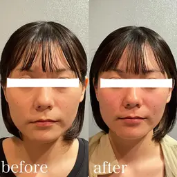 当店人気No.2☆小顔コルギ＋頭蓋骨調整+デコルテ★