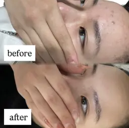 [口コミ必須🙏]オープン価格🌿毛穴洗浄×ハーブピーリング🌿肌の奥から悩みを改善できる最新ハーブピーリング🔥