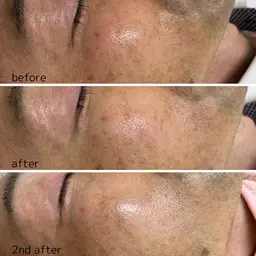 ダウンタイムなし！美容初心者の方にも🔰マンデル酸入ピーリング💊ターンオーバーを促進✨ニキビ、シミ、しわ、くすみに◎✨