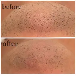 メンズ限定！ご新規様【ミニモ限定】自分で選べる部分脱毛✨✨