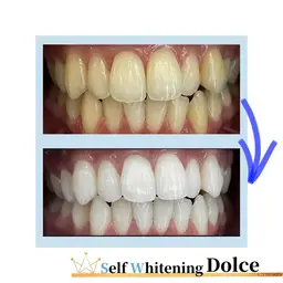 ホワイトニングのコースに悩まれた方、他のサロンや歯科医とで検討中の方はこちら💁‍♀️勧誘は一切いたしません‼︎!