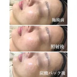 毎月10名様限定‼️光フェイシャル【くすみ/赤ら顔/シミ】コラーゲンの生成も促してお悩み改善♪
