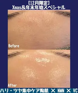 【12月人気ナンバーワン！】【Xmas＆年末年始限定】最高峰NMN×高濃度VCF！ハリ・ツヤ集中剥けないハーブ