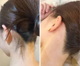 うなじスッキリ脱毛✨