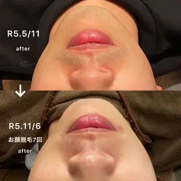 【女性に人気のお顔脱毛】気になる黒い毛、産毛や毛穴まで綺麗に✨