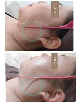 【初回限定】シワ・リフトアップ改善コース