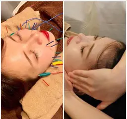 🌹人気No.1🌹美容鍼と小顔の欲張りセット