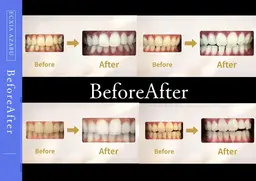 【minimo 限定】　9分2回施術で美白効果◎　ポリリン酸配合