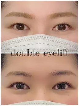 宗像市初✨✳︎ダブルアイリフト✳︎アイストレッチと専用まつ毛パーマで二重が定着しやすくなります🫶🏻