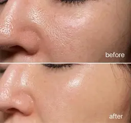 【最強美肌コース】ララピール×原液100%エクソソームのダブル施術で、相乗効果❕最強美肌に💫