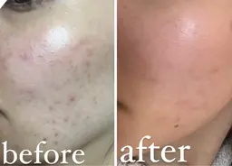 つるんとした手触りへ【毛穴洗浄&発酵セラミド/炭酸パック】