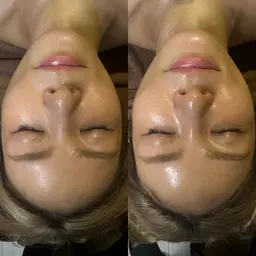 【光フェイシャル】光フェイシャル全顔✨シェービング＆ハイドロパック付き💆‍♀️🫧　¥7,100