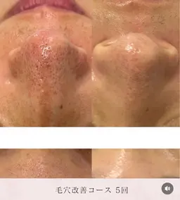 【毛穴の詰まり•黒ずみ•開き】に✨ハイドラ毛穴洗浄✒️水光パック付き🫧