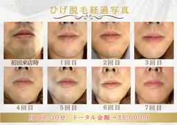 顔脱毛(両頬、鼻下、顎先、顎下、首)ひげ、メンズ脱毛