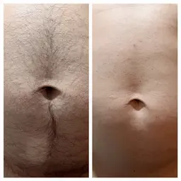 ご新規様限定✨メンズ脱毛(vio込み)