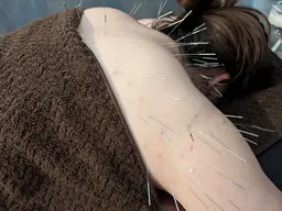 首・肩こり必見！頭から肩甲骨まで最大100本打ち放題鍼おキュウコース