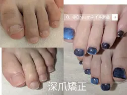 🌟深爪、噛み爪、むしり爪矯正フット長さだしワンカラーコース
