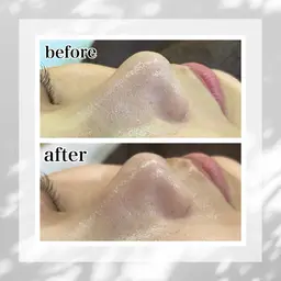 1日1名 【いちご鼻をなんとかしたい方限定】鼻のみ!毛穴洗浄お試し20分