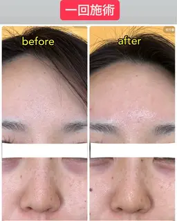 お正月で荒れたお肌をケア!お肌もっちもちぷるぷる!一万円分の美容液パックを使ったドライヘッドスパ!骨盤矯正つき!