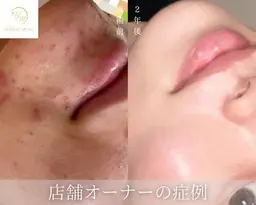 【顔ハーブピーリング✨🫧】ニキビ肌ケア　(皮剥けなし)¥22,000→¥9,000