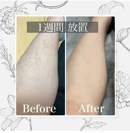女性限定✴︎全顔vio付き全身脱毛1回