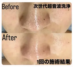 大好評10時～15時限定★魅惑のうる艶肌プルプル毛穴洗浄＆イオン導入＋パッティング韓国白玉レチノール＋ヘッドスパ付き