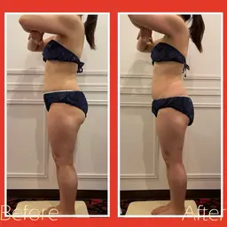 イベント前に！ハイパーナイフ痩身エステ🔥上半身or下半身選べる3回集中ケア💪ガッツリBODYライン作り👙