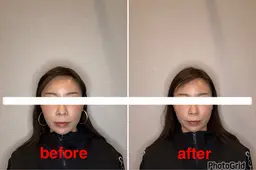 【午前限定】📸before/after写真募集中✨お悩み集中ケア美容鍼10本※補足説明をご確認ください