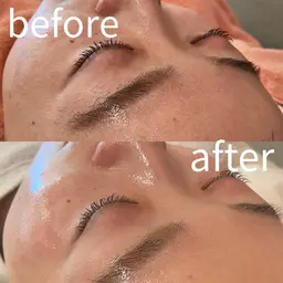 👉透明感UP✨くすみごと脱ぐ美白顔脱毛体験8400円→5500円（フォロー＆口コミご協力条件）