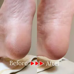 【かかとガサガサ悩みに】足裏角質ケア