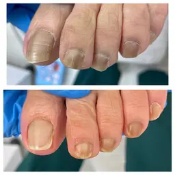 フット足爪10本ケア