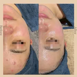 【モニター募集】ヒト幹細胞ハーブピーリング