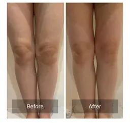 【下半身集中】美脚・美尻が叶うスピード痩身