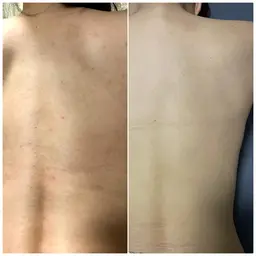 【女性限定】背中美人に肌荒れ改善 背中ゴマージュ