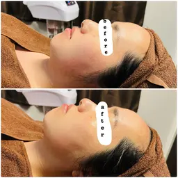 【お顔の筋トレ】EMSで小顔・リフトアップ