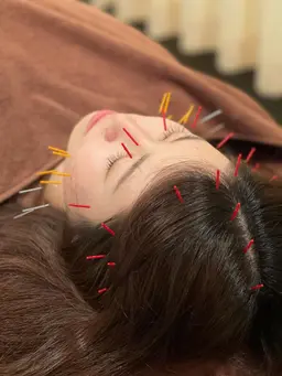 『🎁12月限定🎄』人気の美容鍼✨美容には必須‼︎直後効果◎