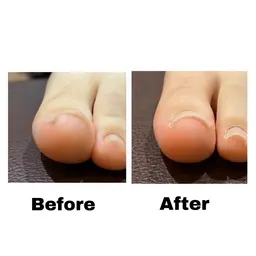 フット巻き爪矯正(ジェルもやる方はマイナス6000円)