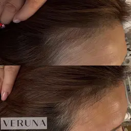 オープン記念‼️髪・頭皮の悩みに✨VERUNAスカルプ棘ケア（ご希望箇所へのスポット施術）＋ドライヘッドスパ20分