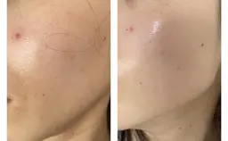 💖21日限定💖【毛穴撲滅コース】脱毛美肌へレイビス独自2段階シェービング付🌷エステ×脱毛だから導ける美肌を体感