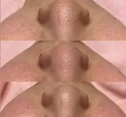 今話題の🔥毛穴エクストラクション🔥🫧最強毛穴撲滅メニュー‼️ブラックヘッドから毛穴の開きまで、毛穴の事ならお任せ!