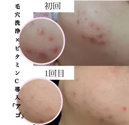 【黒毛穴×ニキビケア】大人気!全顔毛穴洗浄+スーパービタミンC微弱電流導入+ミニモ限定高保湿クリーム¥5500