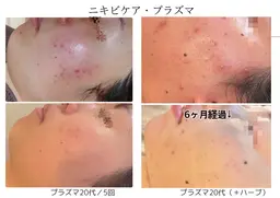 【モニター¥0／3名限定募集】水光プラズマ　ニキビ肌・凸凹跡・肌荒れ    ※現在3/3と3/6のご予約受付中です。