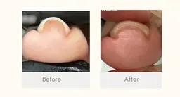 新メニュー✨　巻き爪改善ネイル【foot】