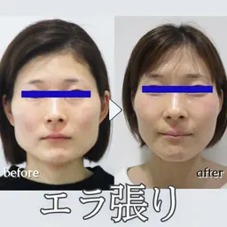 👑全国人気NO.1！👑【小顔矯正+美顔マッサージ】+【首肩矯正】💆 50分＜顔やせ/エラ張り/首を長く細くなど＞