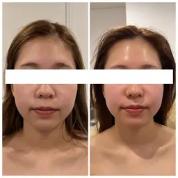 👑小顔ケアNo.1✨本格コルギで瞬間小顔リセット🤍輪郭デザイン💫コルギ&ハイパーナイフEXで小顔へchange💖