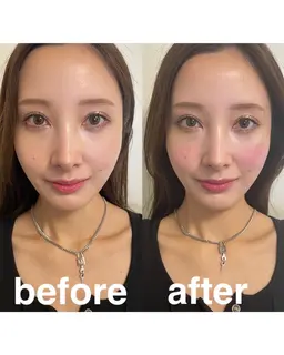学割👩🎓🌸【小顔、むくみ改善】美容鍼/特別価格11800円→4990円 ✨フェイスラインスッキリ✨