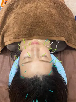 人気No.1☆美容鍼×セルキュアエステ満足コース 【つやつや小顔】