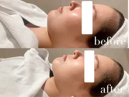 【モニター様限定】小顔施術大人気クーポン🍋