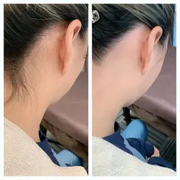 🩷うなじブラジリアンワックス🩷